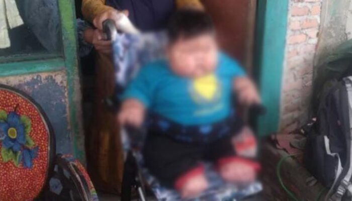 Balita Asal Tarumajaya Bekasi Alamai Obesitas, Bobot Capai 27 Kilogram