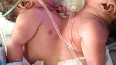 Bayi perempuan, Zarifah Sakinah Mecca dan Tanisha Zara Mecca menunggu bantuan untuk biaya dari uluran tangan dermawan. (Foto : istimewah)
