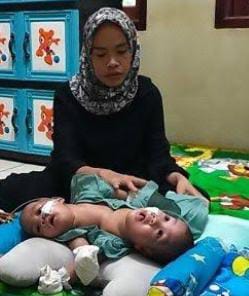 Bayi perempuan, Zarifah Sakinah Mecca dan Tanisha Zara Mecca menunggu bantuan untuk biaya dari uluran tangan dermawan. (Foto : istimewah)