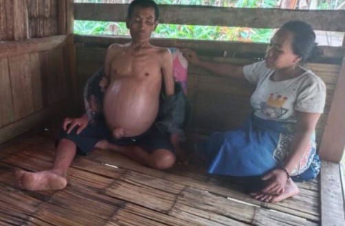 Kondisi Mujani, warga Kampung Kadu Kolecer Rt 02 Rw 04 Desa Babakanlor, Kecamatan Cikedal, Kabupaten Pandeglang mengalami pembengkakan perut. (Foto: istimewah)