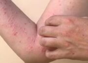 Mengerikan, Dua Warga Banten Positif Terpapar Cacar Monyet