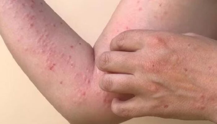 Mengerikan, Dua Warga Banten Positif Terpapar Cacar Monyet