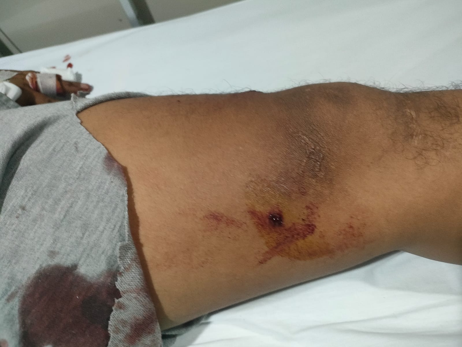 Seorang warga tertembak kakinya oleh komplotan perampok (foto: istimewa)