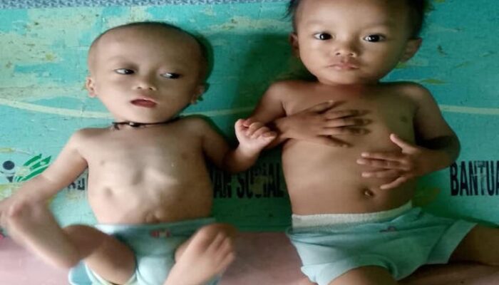 Bayi Kembar di Labuan Banten Butuh Bantuan
