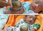 Bayi di Pandeglang Lahir dengan Usus Diluar Perut, Membutuhkan Pertolongan Medis dan Bantuan Donatur
