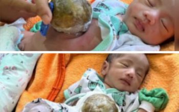 Bayi di Pandeglang Lahir dengan Usus Diluar Perut, Membutuhkan Pertolongan Medis dan Bantuan Donatur