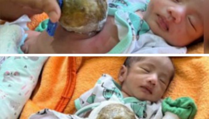 Bayi di Pandeglang Lahir dengan Usus Diluar Perut, Membutuhkan Pertolongan Medis dan Bantuan Donatur