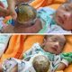 Bayi di Pandeglang Lahir dengan Usus Diluar Perut, Membutuhkan Pertolongan Medis dan Bantuan Donatur